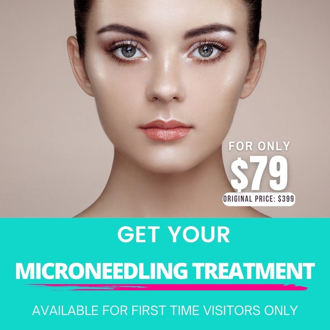 LIMITED OFFER $79 MICRONEEDLING IN COLORADO – Welcome To Lilly ...