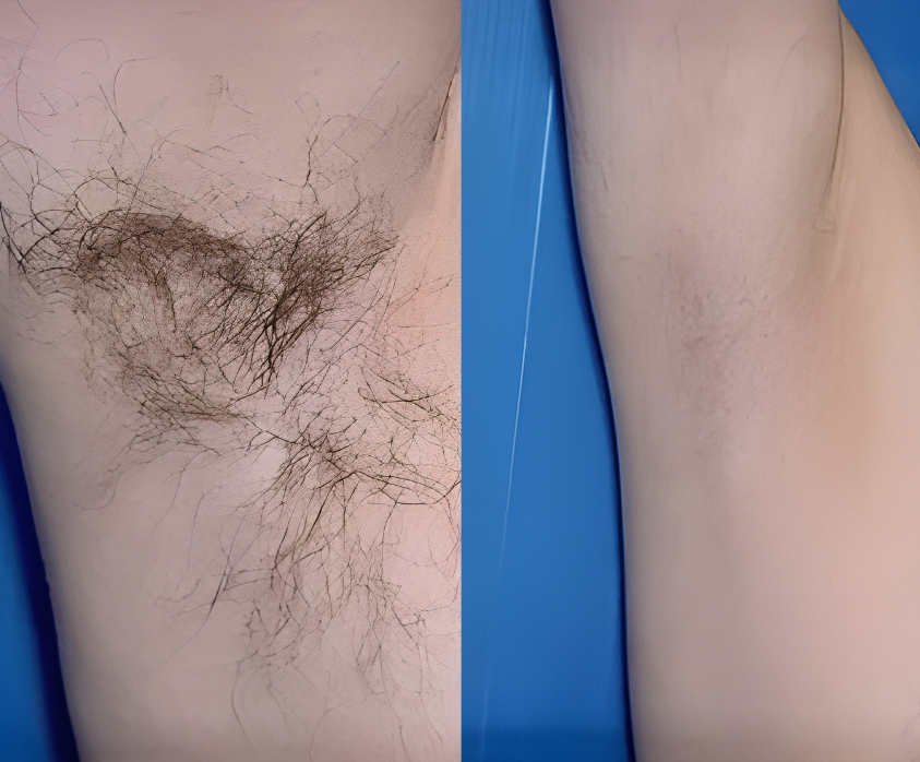 laser-hair-removal-before-after-results-1 (1)