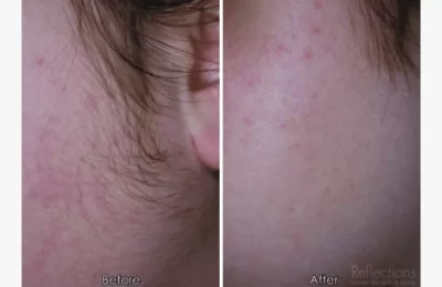 Before-and-after-of-laser-hair-removal-1296x728-slide2