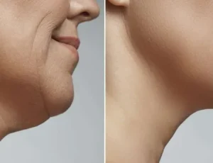 The-Best-Jawline-Sculpting-Treatments--1024x473.jpg