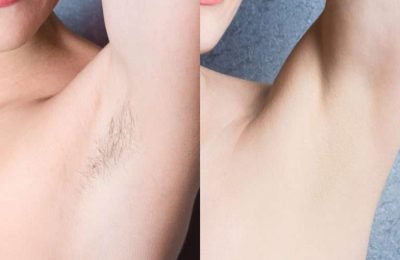 hair-removal-before-and-after-768x512