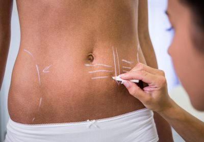 Close-up of surgeon drawing lines on womans abdomen for liposuction and cellulite removal